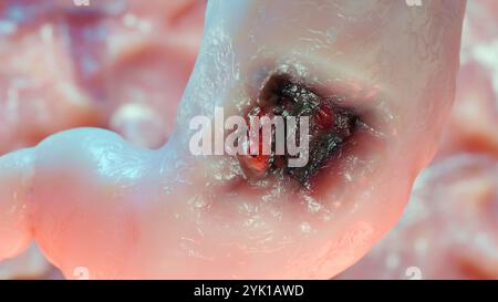 Cancro allo stomaco. Stadi crescita tumorale nell'apparato digerente, anatomia dell'ulcera peptica, cellula di attacco del cancro. concetto di malattia gastrica. sintomi, può maligno Foto Stock