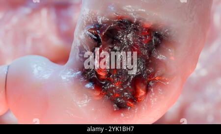 Cancro allo stomaco. Stadi crescita tumorale nell'apparato digerente, anatomia dell'ulcera peptica, cellula di attacco del cancro. concetto di malattia gastrica. sintomi, può maligno Foto Stock