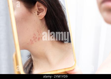 La donna esamina allo specchio la sua acne infiammata sul collo e sull'area della mandibola. Concetto di trattamento della pelle problematica. Concetto di cosmetologia. Foto Stock