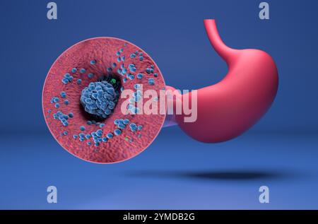 Cancro dello stomaco (gastrico) - Vista isometrica illustrazione 3d. Foto Stock