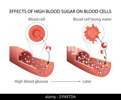 Effetti di un alto livello di zucchero nel sangue sulle cellule del sangue Foto Stock