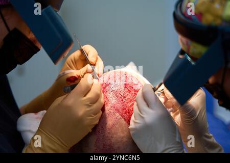 Chirurghi che eseguono la procedura di trapianto di capelli con strumenti chirurgici Foto Stock