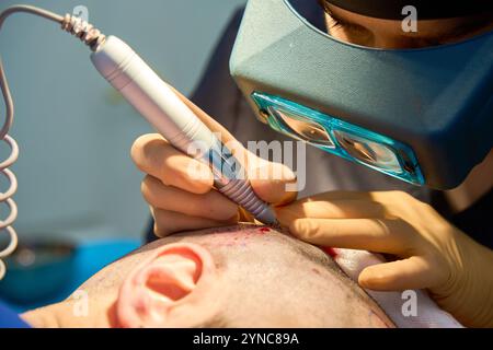 primo piano di un medico che estrae follicoli per l'innesto di capelli Foto Stock