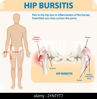 Illustrazione della borsite dell'anca e delle aree interessate Illustrazione Vettoriale