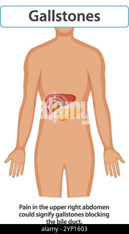 Illustrazione di calcoli biliari che influenzano il corpo umano Illustrazione Vettoriale