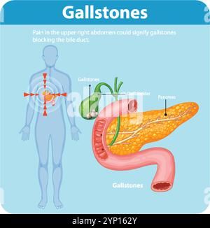 Illustrazione di calcoli biliari che influenzano il corpo umano Illustrazione Vettoriale