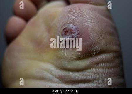 Fioriere infette del piede verruche e blister dopo il congelamento con azoto liquido. Foto Stock