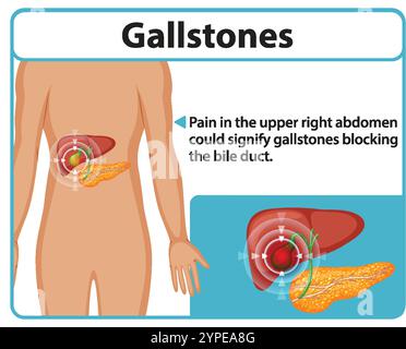 Illustrazione di calcoli biliari che influenzano il dotto biliare Illustrazione Vettoriale