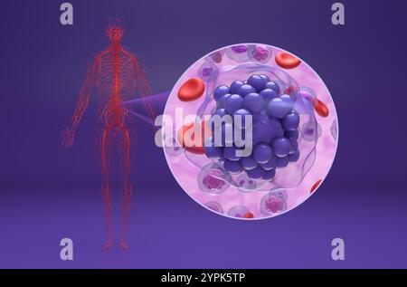 Linfoma diffuso a grandi cellule B (DLBCL) - Vista isometrica illustrazione 3d. Foto Stock
