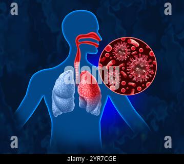 Malattia respiratoria acuta o ARD che colpisce diverse parti delle vie respiratorie, tra cui naso gola vie respiratorie e polmoni infettati da un ba virale Foto Stock
