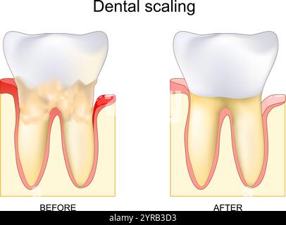 Procedura dentale per la rimozione del tartaro prima e dopo. Calcolo dentale. Pulizia o incrostazione professionale. Malattia gengivale. Infiammazione gengivale vicino a Bact Illustrazione Vettoriale