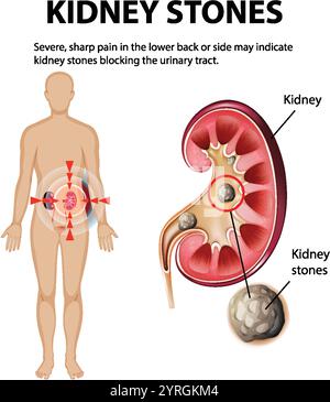 Illustrazione di calcoli renali che causano dolore grave Illustrazione Vettoriale