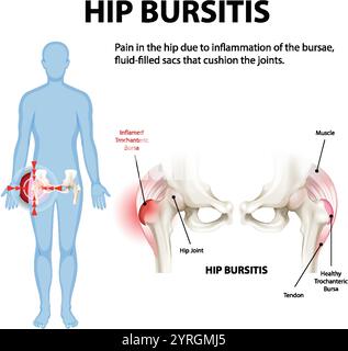 Illustrazione di borsite dell'anca e infiammazione articolare Illustrazione Vettoriale