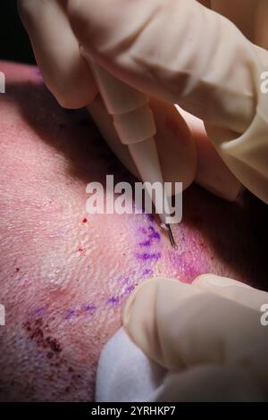 Primo piano di un chirurgo che esegue un trapianto di capelli, evidenziando la precisione nel posizionamento del follicolo pilifero sulle mani con i guanti e sullo strumento chirurgico Foto Stock