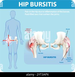 Illustrazione della borsite dell'anca e delle aree interessate Illustrazione Vettoriale