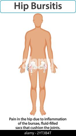 Illustrazione di borsite dell'anca e infiammazione articolare Illustrazione Vettoriale