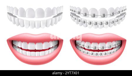 Denti con o senza bretelle. Rinforzi ad arco senza denti. Odontoiatria ortodontica. L'allineamento dei denti. Sorridi con denti e bretelle bianchi. Isolare Illustrazione Vettoriale