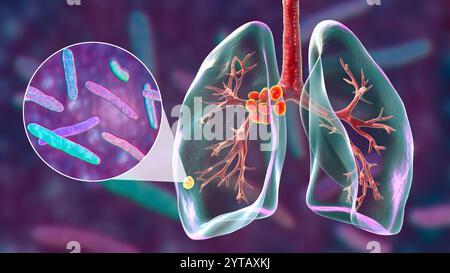 Tubercolosi polmonare primaria. Illustrazione computerizzata del complesso Ghon e della linfoadenite mediastinica, insieme a una vista ravvicinata dei batteri Mycobacterium tuberculosis. Foto Stock