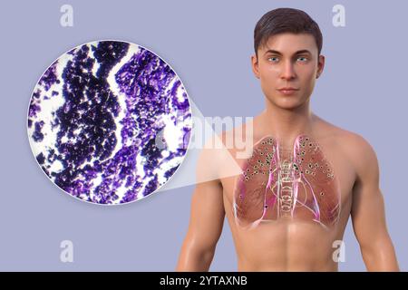 Illustrazione al computer e micrografia leggera di un uomo con polmoni affetti da silicosi, rivelando noduli silicotici scuri. Foto Stock