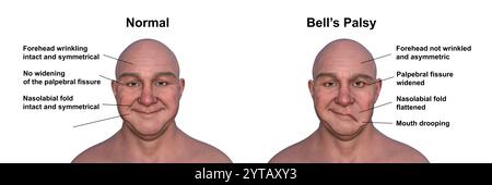 Paralisi facciale in un uomo, e la stessa persona sana. Illustrazione computerizzata che evidenzia l'asimmetria e il gocciolamento dei muscoli facciali su un lato del viso in paralisi facciale. Foto Stock