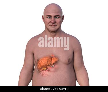 Illustrazione computerizzata di un uomo con pelle trasparente, che rivela un fegato grasso, evidenzia l'anatomia del fegato e l'accumulo di grasso. Foto Stock
