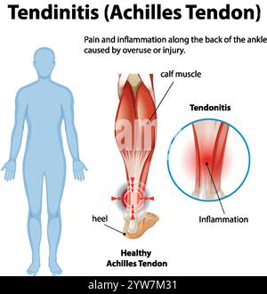 Diagramma che mostra l'infiammazione e il dolore del tendine d'Achille Illustrazione Vettoriale