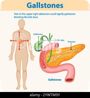 Illustrazione di calcoli biliari che interessano la colecisti e il pancreas Illustrazione Vettoriale