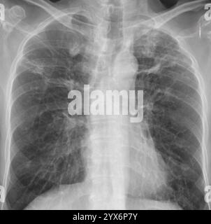 Radiografia dei polmoni di un paziente con tubercolosi polmonare che colpisce entrambi i polmoni. La tubercolosi polmonare è causata dal batterio Mycobacterium tuberculosis, che si diffonde per tosse e starnuti. I batteri creano tubercoli primari, lesioni nodulari dei polmoni. I sintomi includono febbre, perdita di peso e tosse di sangue. Il trattamento è con antibiotici a lungo termine. Foto Stock