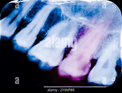 Raggi X periapicali colorati delle cavità, o carie, in un secondo molare mandibolare in alto a sinistra (il secondo da destra). Una radiografia periapicale mostra l'intero dente, dalla corona alla punta della radice. Foto Stock