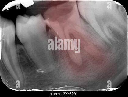 Raggi X periapicali colorati di un primo dente molare sinistro mandibolare che mostra cavità, o carie, e una lesione periapicale (intorno all'apice della radice del dente) che è indicativa di un ascesso periapicale. Una radiografia periapicale mostra l'intero dente, dalla corona alla punta della radice. Foto Stock