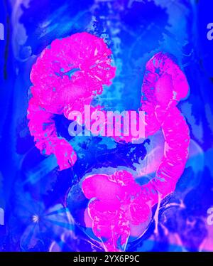 Radiografia frontale colorata di un colon sano (intestino crasso). Il colon è la parte finale del tratto digerente, dove l'acqua viene assorbita dal cibo digerito e si formano feci solide. Un mezzo di contrasto al bario è stato introdotto nel colon per renderlo visibile sui raggi X. Foto Stock