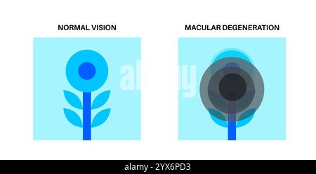 Degenerazione maculare, illustrazione. Foto Stock