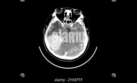 Scansione di tomografia computerizzata assiale (TC) della testa di un paziente che mostra un meningioma (bianco, in basso a sinistra). Si tratta di un tumore benigno (non canceroso) che nasce dalle meningi, le membrane che circondano il cervello. Foto Stock