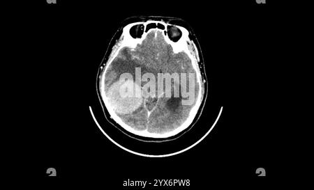 Scansione di tomografia computerizzata assiale (TC) della testa di un paziente che mostra un meningioma (bianco, in basso a sinistra). Si tratta di un tumore benigno (non canceroso) che nasce dalle meningi, le membrane che circondano il cervello. Foto Stock