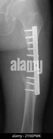 Radiografia di un femore fratturato (osso della coscia) fissato internamente con piastre e viti. Si tratta di una frattura patologica, che è una frattura causata da un indebolimento dell'osso piuttosto che da un trauma. Foto Stock