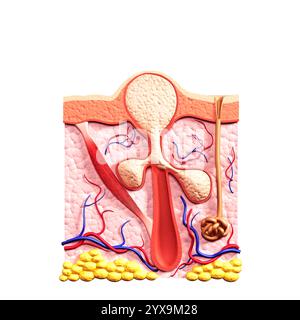 Sezione trasversale della Pelle che mostra follicolo pilifero riempito di sebo, pus o globuli bianchi, e le ghiandole sebacee, causando un whitehead brufolo o acne. 3 medici Foto Stock