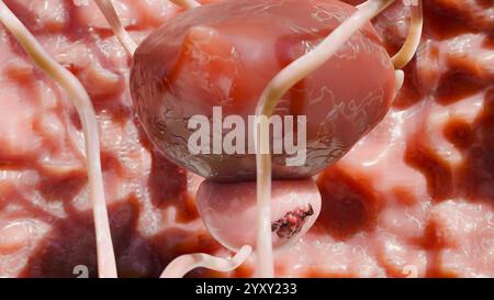 Stadi del cancro alla prostata. cellule ancerose, tumore maligno comprime l'uretra. Disturbo patologico, sistema riproduttivo genitale, canale alfa, bladd Foto Stock