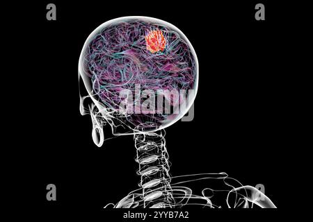Illustrazione al computer di un tumore al cervello. Foto Stock