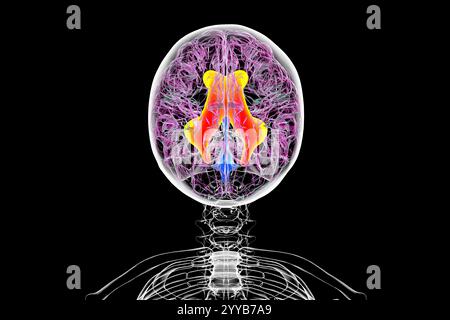 Illustrazione computerizzata dei ventricoli laterali ingranditi (idrocefalo) del cervello. Foto Stock