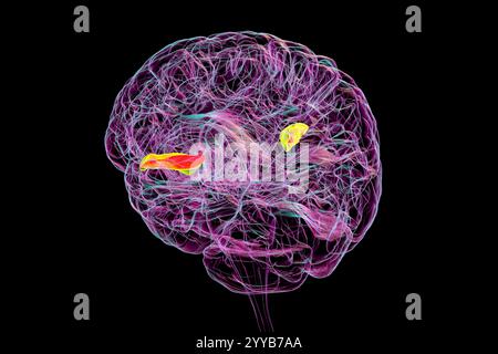 Illustrazione computerizzata di un cervello umano con il giroscopio temporale trasversale evidenziato, anteriore in verde e posteriore in arancione. Queste regioni sono coinvolte nell'elaborazione uditiva e nella comprensione del linguaggio. Foto Stock