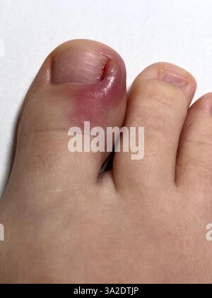 Unghie incarnite con infiammazione sulle unghie del piede a causa di batteri che causano infiammazione. Dolore bruciante e suppurazione all'alluce richiedono un trattamento chirurgico in una struttura medica. Ho bisogno di prendere antibiotici o antidolorifici. Foto di alta qualità Foto Stock