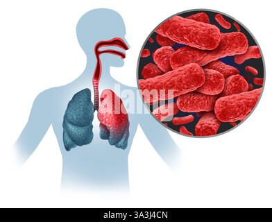 Mycobacterium tuberculosis infezione focolaio e trasmissione TB come infezioni batteriche contagiose a causa di batteri infettivi che infettano i polmoni Foto Stock