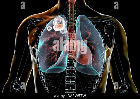 Illustrazione della tubercolosi cavitaria nel lobo superiore del polmone destro, organo, organi, che mostra danni polmonari e cavità. Foto Stock
