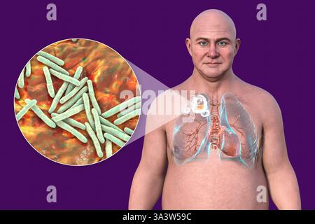 Illustrazione di un uomo con polmoni affetti da tubercolosi cavitaria nel lobo superiore destro, che mostra danni polmonari e cavità, insieme a una vista ravvicinata dei batteri Mycobacterium tuberculosis. Foto Stock
