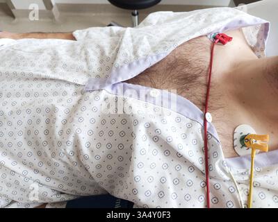 Elettrodi ECG o ECG o elettrocardiogramma collegati al torace di un uomo caucasico. Sdraiato nel letto d'ospedale, camice paziente medico, colpo ravvicinato, unrecogni Foto Stock