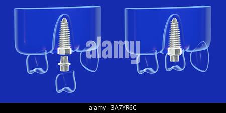 Illustrazione 3D di un impianto dentale in uno stile grafico misto e trasparente. In due fasi, prima e dopo il posizionamento. Foto Stock