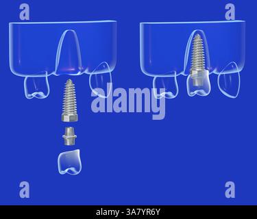 Illustrazione 3D di un impianto dentale in uno stile grafico misto e trasparente. In due fasi, prima e dopo il posizionamento. Foto Stock