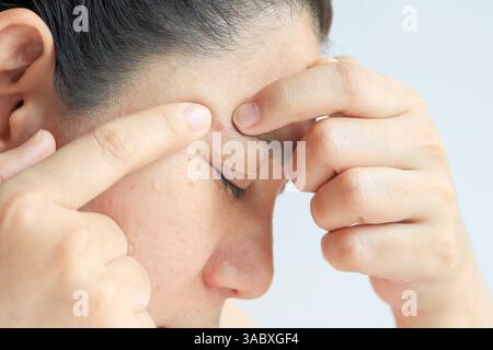 Mano della donna che preme acne infiammato, concetto di salute Foto Stock