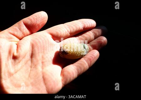Malattia di calcoli biliari, colelitiasi - la formazione di pietre, pietre nella cistifellea, dotti biliari. Calcoli biliari. Un grande gallstone rimosso da un patie Foto Stock