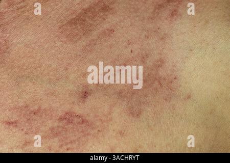 Forti eruzioni cutanee allergiche sulla pelle asiatica, immunità compromessa del corpo e reazione ai prodotti allergici. Foto Stock